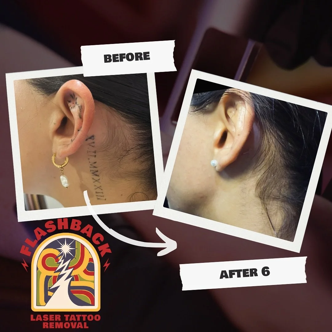 📍Holland Park, Brisbane Monday to Saturday - By Appointment Only  #tattooremoval #tattooremovalresults #tattooremovalbrisbane #brisbanetattooremoval #brisbanetattoo #brisbanetattooartist #brisbanetattoos #tattooregret #brisbanebrows #brisbanebr