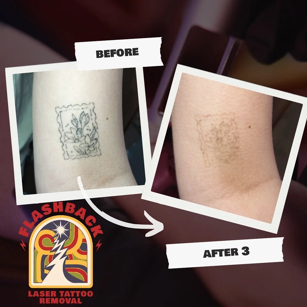 So close to done! 📍Holland Park, Brisbane Monday to Saturday - By Appointment Only  #tattooremoval #tattooremovalresults #tattooremovalbrisbane #brisbanetattooremoval #brisbanetattoo #brisbanetattooartist #brisbanetattoos #tattooregret #brisban
