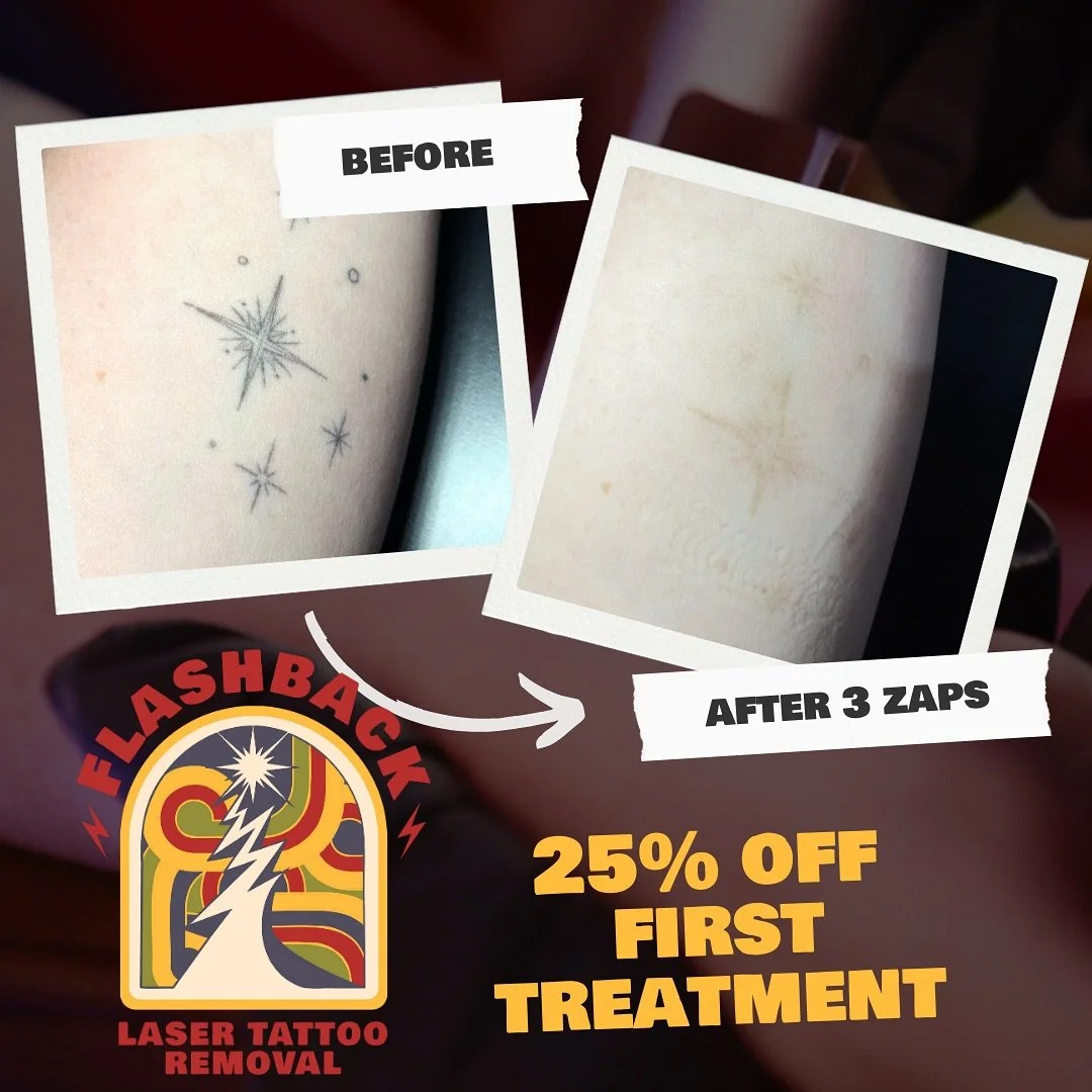 #TattooRemoval #LaserTattooRemoval #TattooRemovalJourney #RemoveYourTattoo #TattooRemovalProcess #GoodbyeTattoo #EraseThePast #ClearSkinJourney #TattooFree #SkinConfidence #SkinCareGoals #FreshSkin #SkinRenewal #BeautyClinic #SkinTransformation #Tatt