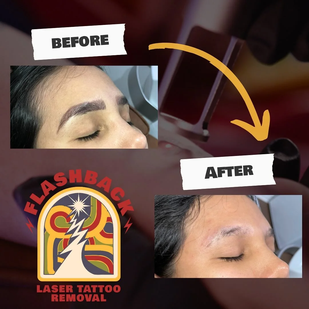 These were a challenge, but we got there!! All ink and techniques for eyebrow tattooing are different, so it&rsquo;s always a fun challenge to see them fade away! #TattooRemoval #LaserTattooRemoval #TattooRemovalJourney #RemoveYourTattoo #TattooRemov