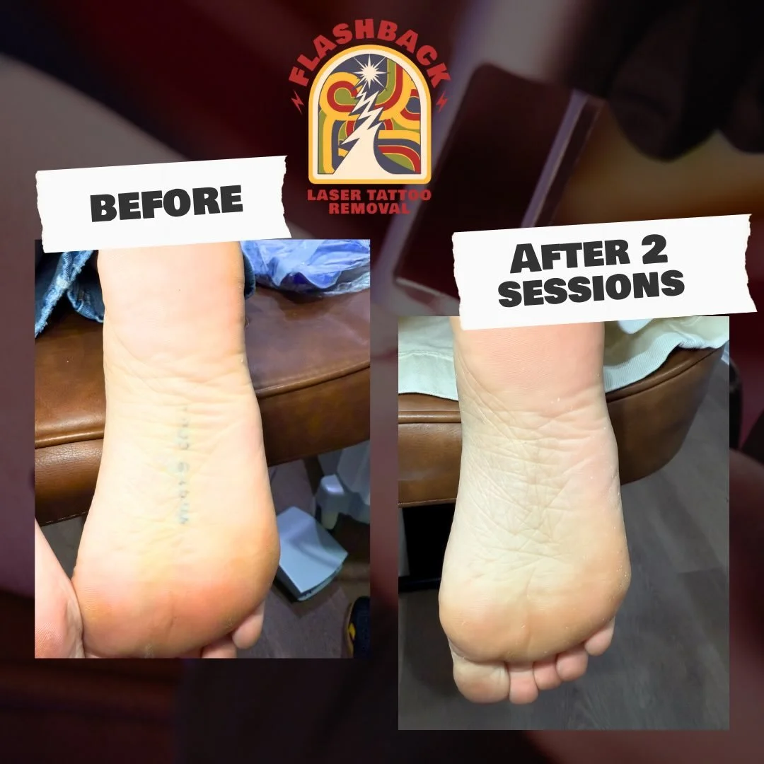 #LaserTattooRemoval #TattooRemoval #BrisbaneTattooRemoval #BrisbaneBeauty #BrisbaneClinic #BrisbaneSmallBusiness #LaserRemoval #BeforeAndAfter #SkinClinicBrisbane #BrisbaneLife #QLDBeauty #AestheticClinic #AestheticBrisbane #TattooRemovalJourney #Pic