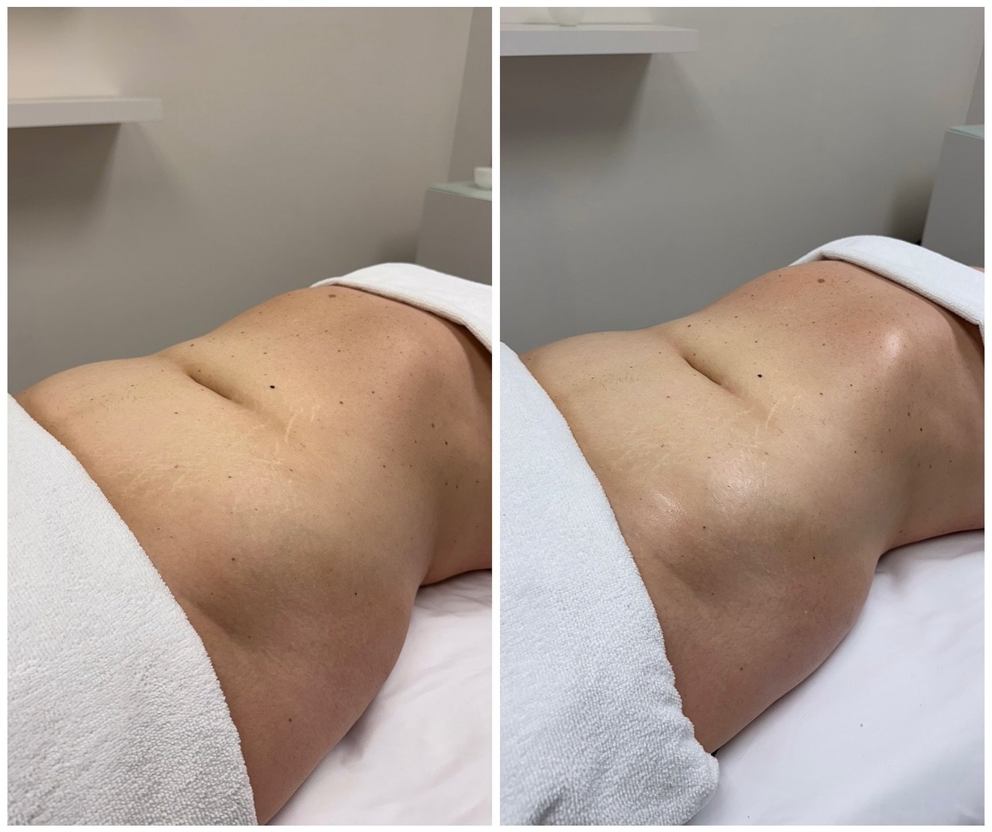 Staring the week with this beautiful before &amp; after✨

#dallaslymphaticmassage #detoxmassage #byebyebloating #wellness #selfcare #beforeandafter #dallastx #letsdrainitall #massagetherapist