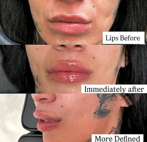 Lip and facial filler before and after, AnatomicL, Cherry Hill NJ – What NOT to do before your filler appointment (Yes