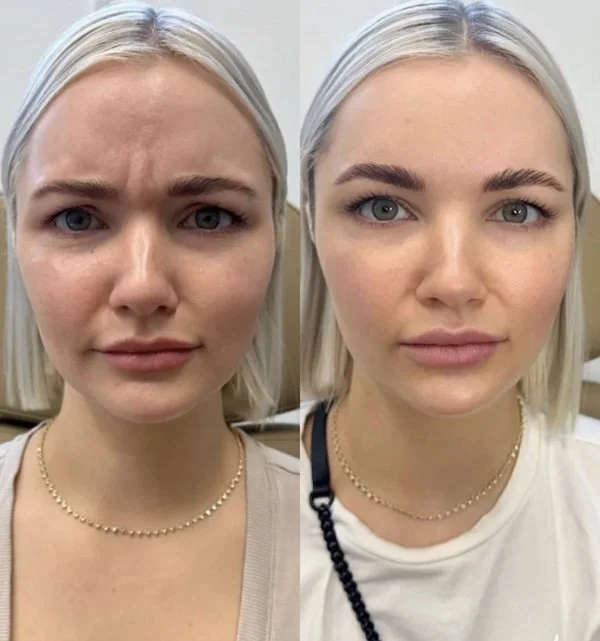 Botox before and after, forehead and frown lines, at AnatomicL Medical Aesthetics in Cherry Hill, New Jersey