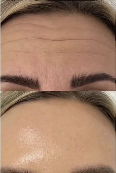 Botox anatomicl med spa new jersey cherry hill philadelphia4.jpg