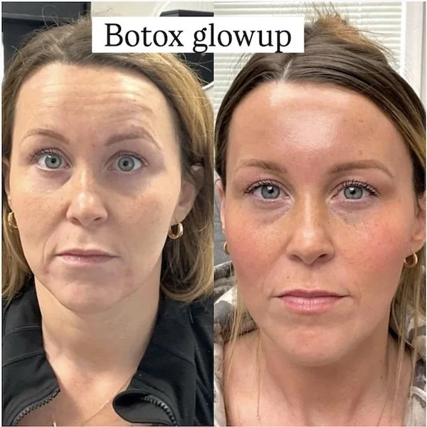 botox anatomicl before and after med spa cherry hill nj7.jpg