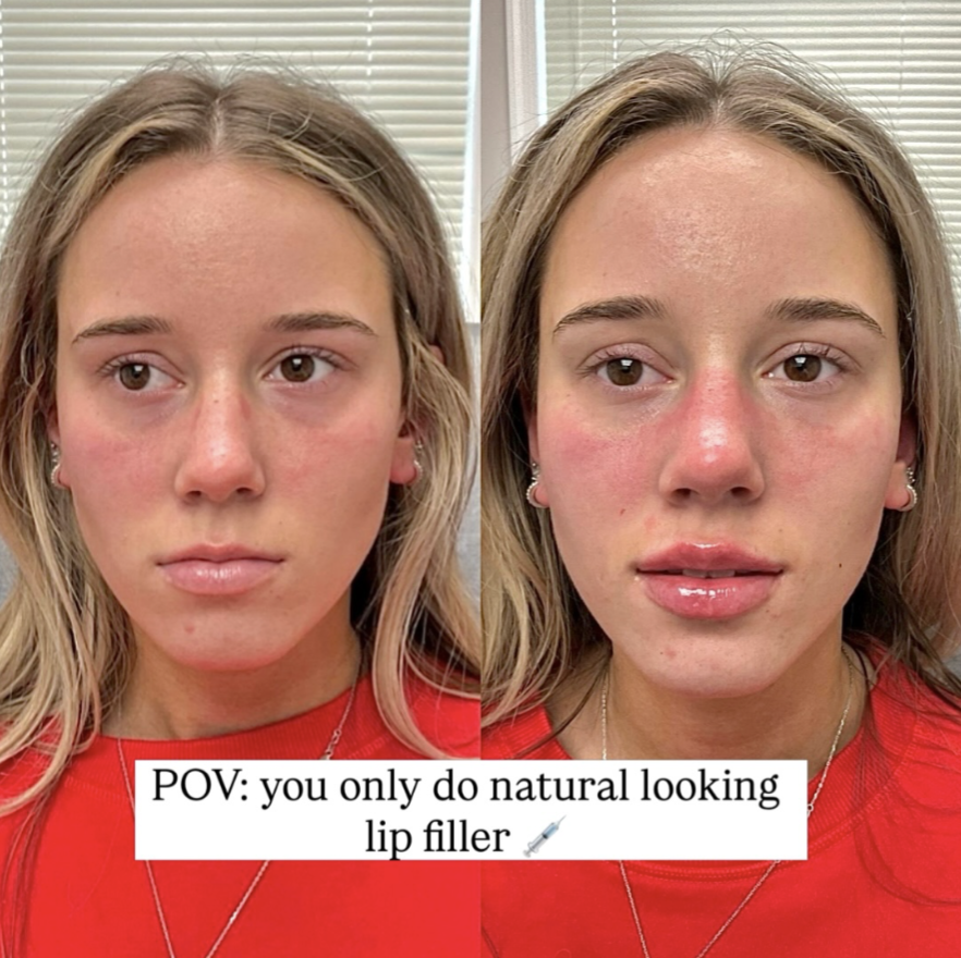 lip filler Cherry hill New Jersey anatomicl medical aesthetics med spa