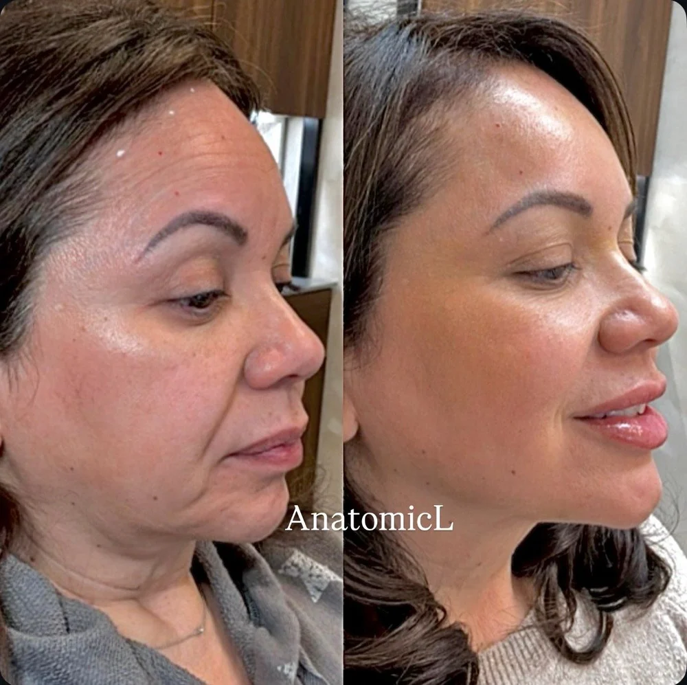 Facial balancing dermal filler before and after at AnatomicL med spa New Jersey