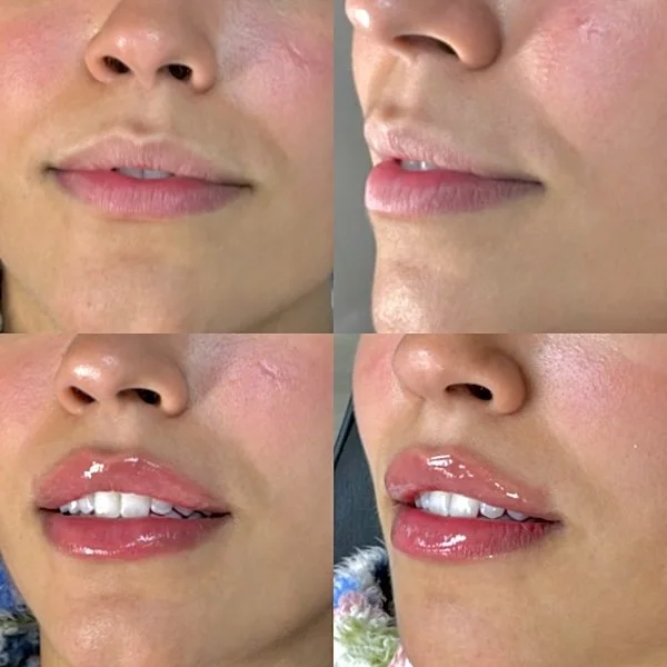 Lip Filler before and after cherry hill new jersey anatomicl