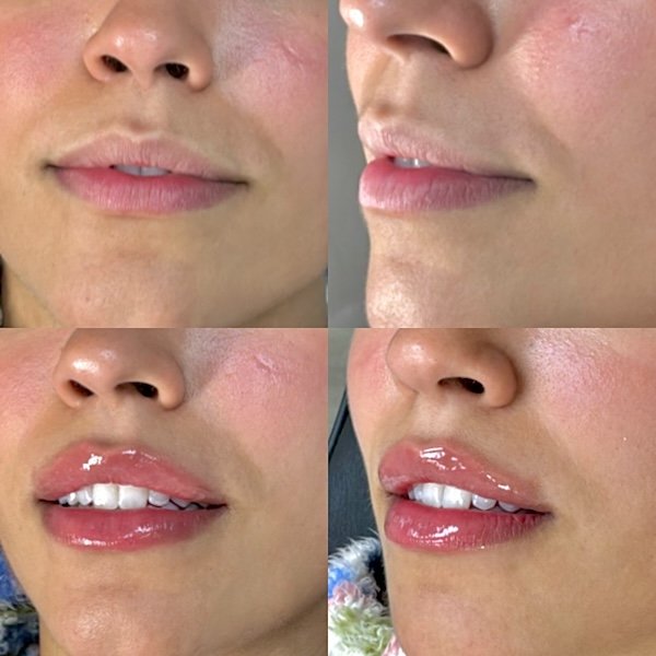 Lip filler before and after at AnatomicL med spa Cherry Hill NJ