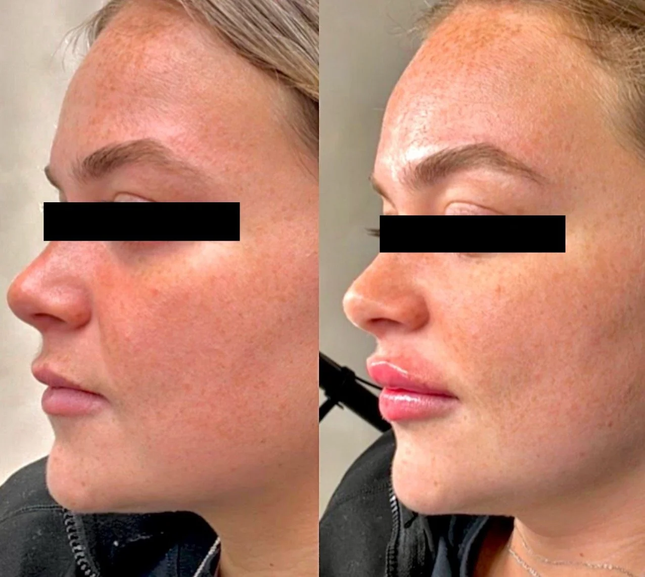 lip filler Cherry hill New Jersey anatomicl medical aesthetics med spa