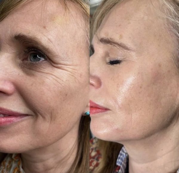 Botox anatomicl med spa new jersey cherry hill philadelphia4.jpg