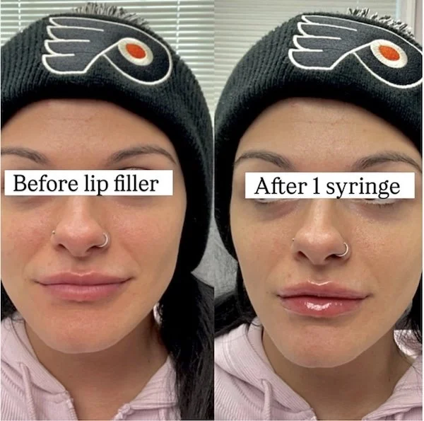 Lip filler results showing added volume and improved symmetry, Cherry Hill NJ med spa