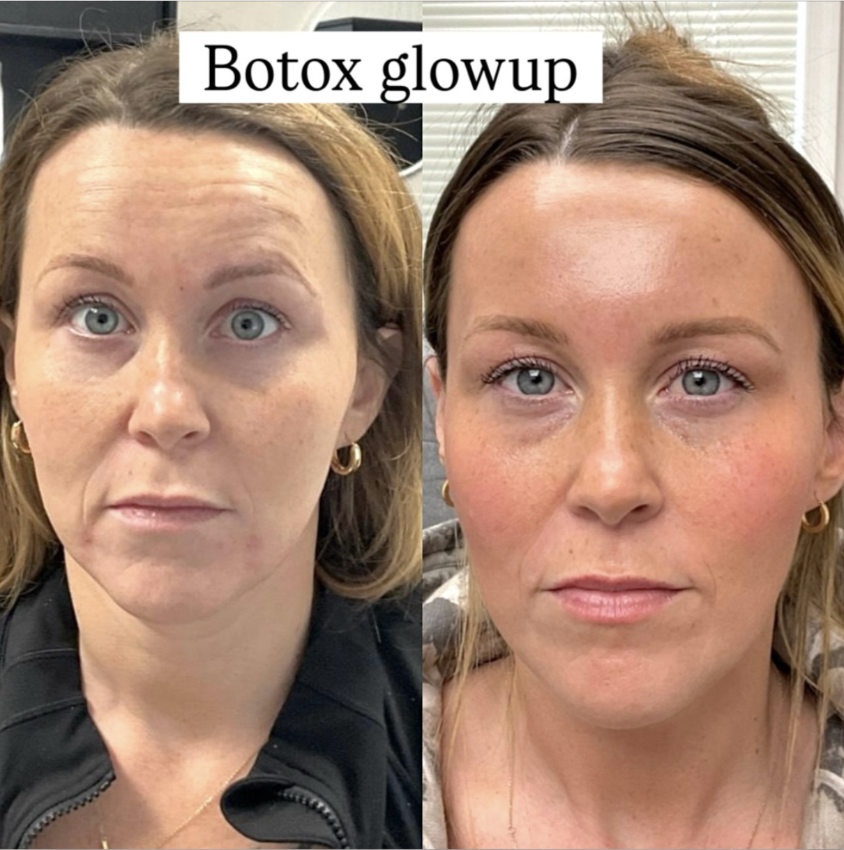 Botox glow up before after Cherry hill New Jersey before and after anatomicl medical aesthetics med spa