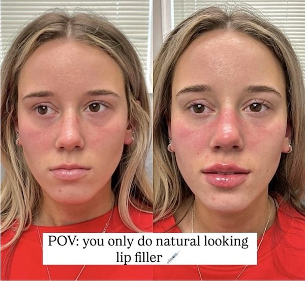 lip filler anatomicl before and after med spa cherry hill nj2.jpg