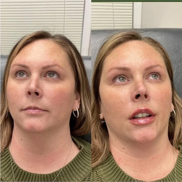 Before and after lip filler photo, natural result, Cherry Hill New Jersey med spa