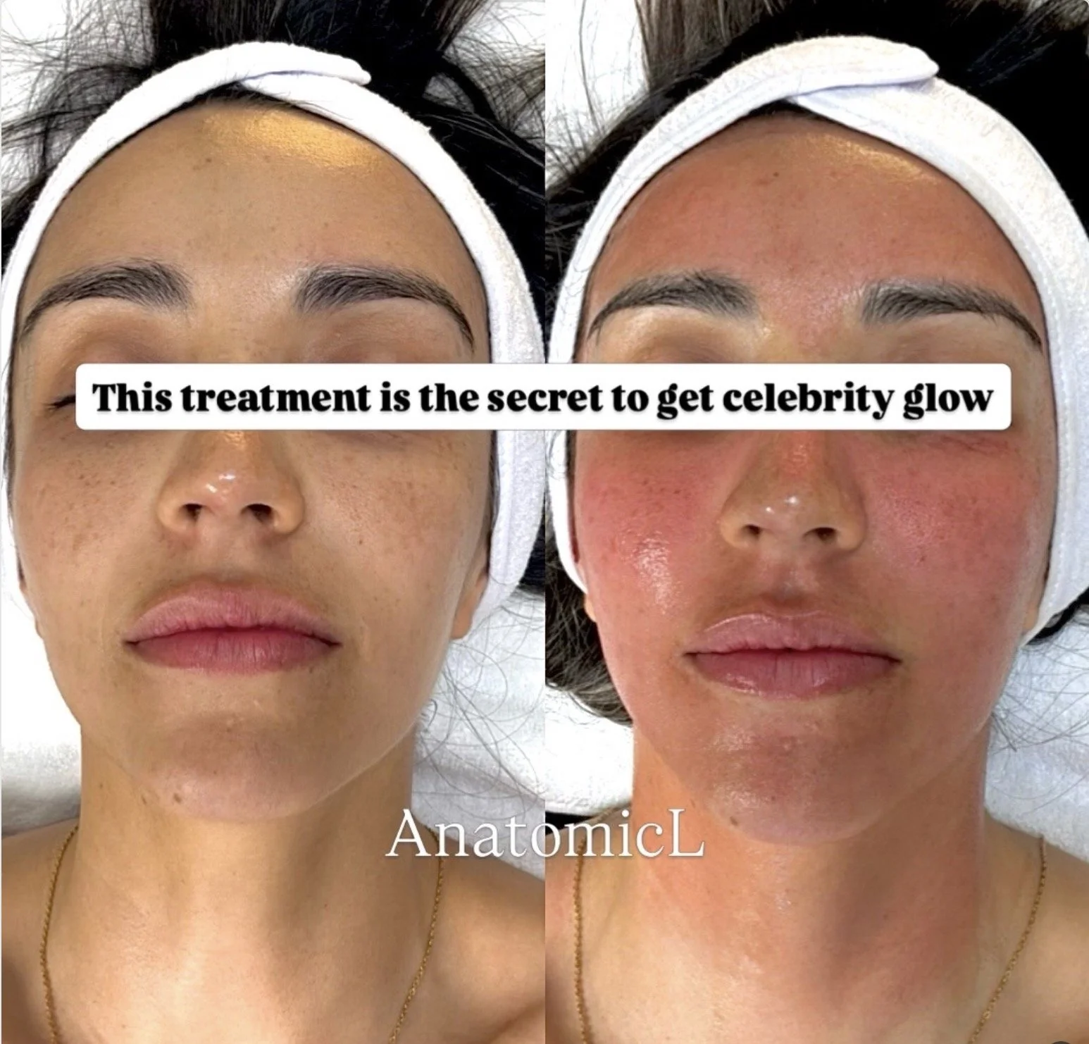 vampire facial cherry hill NJ med spa Anatomicl