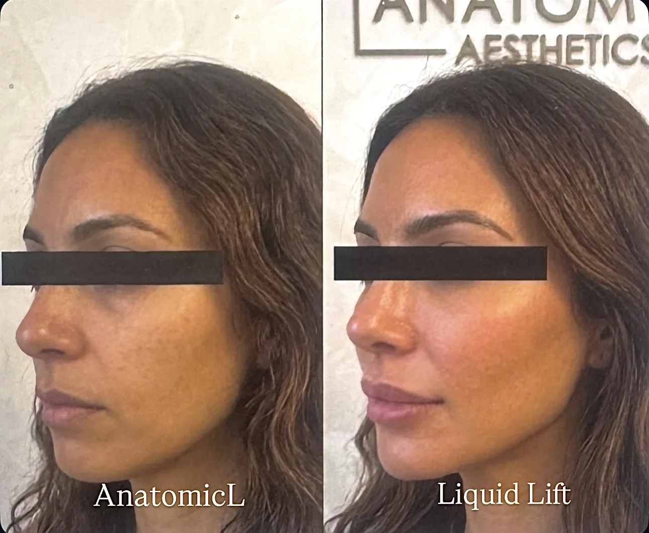 facelift dermal filler anatomicl