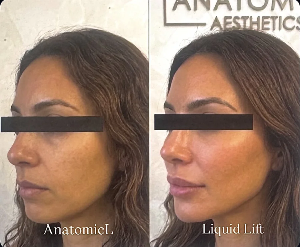 Liquid facelift dermal filler before and after, AnatomicL Cherry Hill NJ