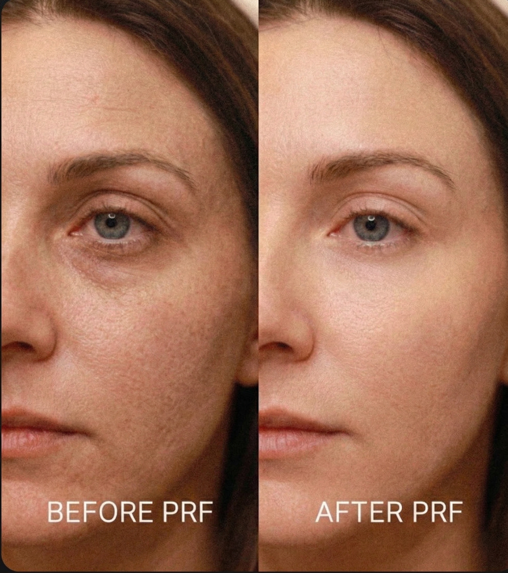 PRF ez gel PRP glow up before after Cherry hill New Jersey before and after anatomicl medical aesthetics med spa