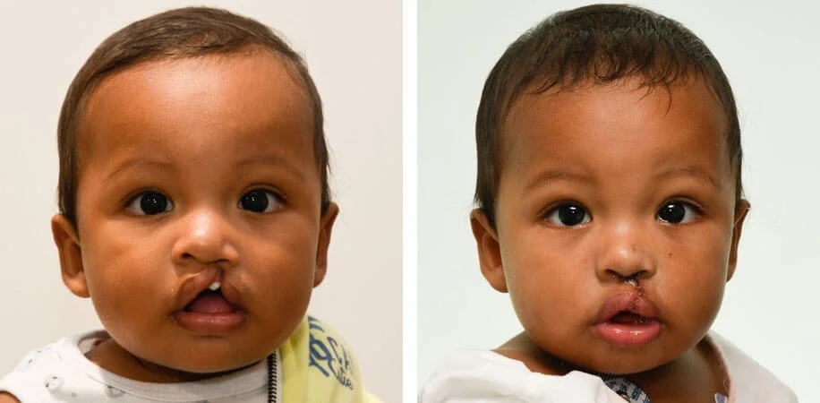  From a Rotaplast mission in Columbia, Manuel is an energetic 7- month- old boy with cleft pallet.  