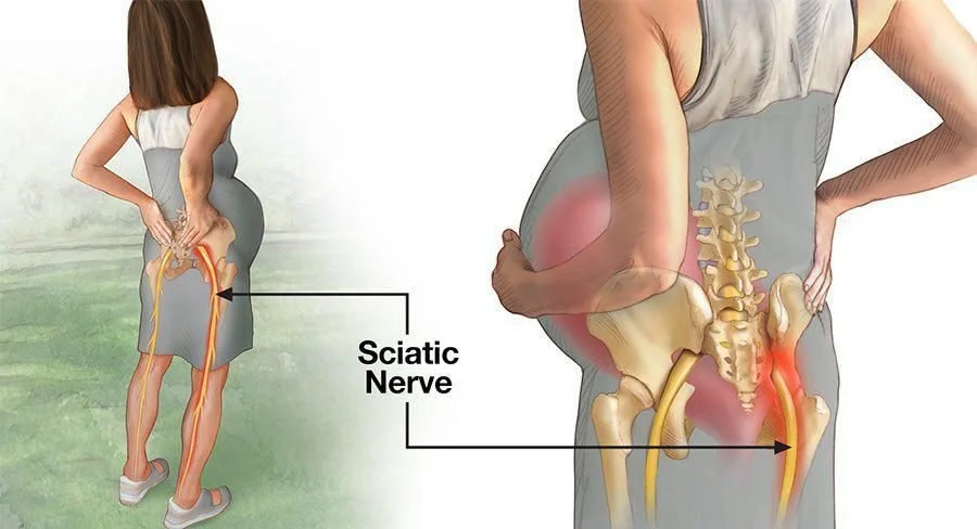 Why You Might Have Sciatica During Pregnancy