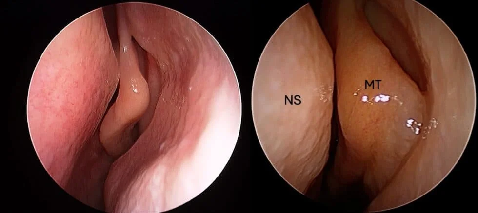 The Missing Cause of Nasal Obstruction