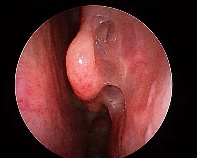 Why Surgery Still Matters in the Era of Biologics