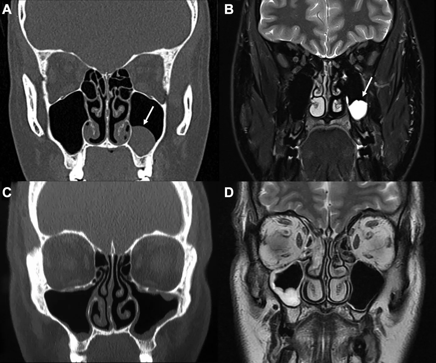 Why ENT Surgeons Must Review Sinus CT Scans — Not Just the Report