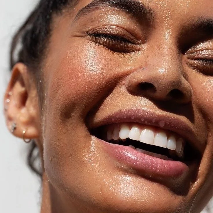 Laser treatment for broken capillaries, pigmentation and redness at BYGOLDEN Parkdale Melbourne