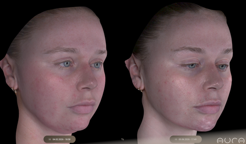 Before and after injectable fat reduction results at BYGOLDEN Parkdale