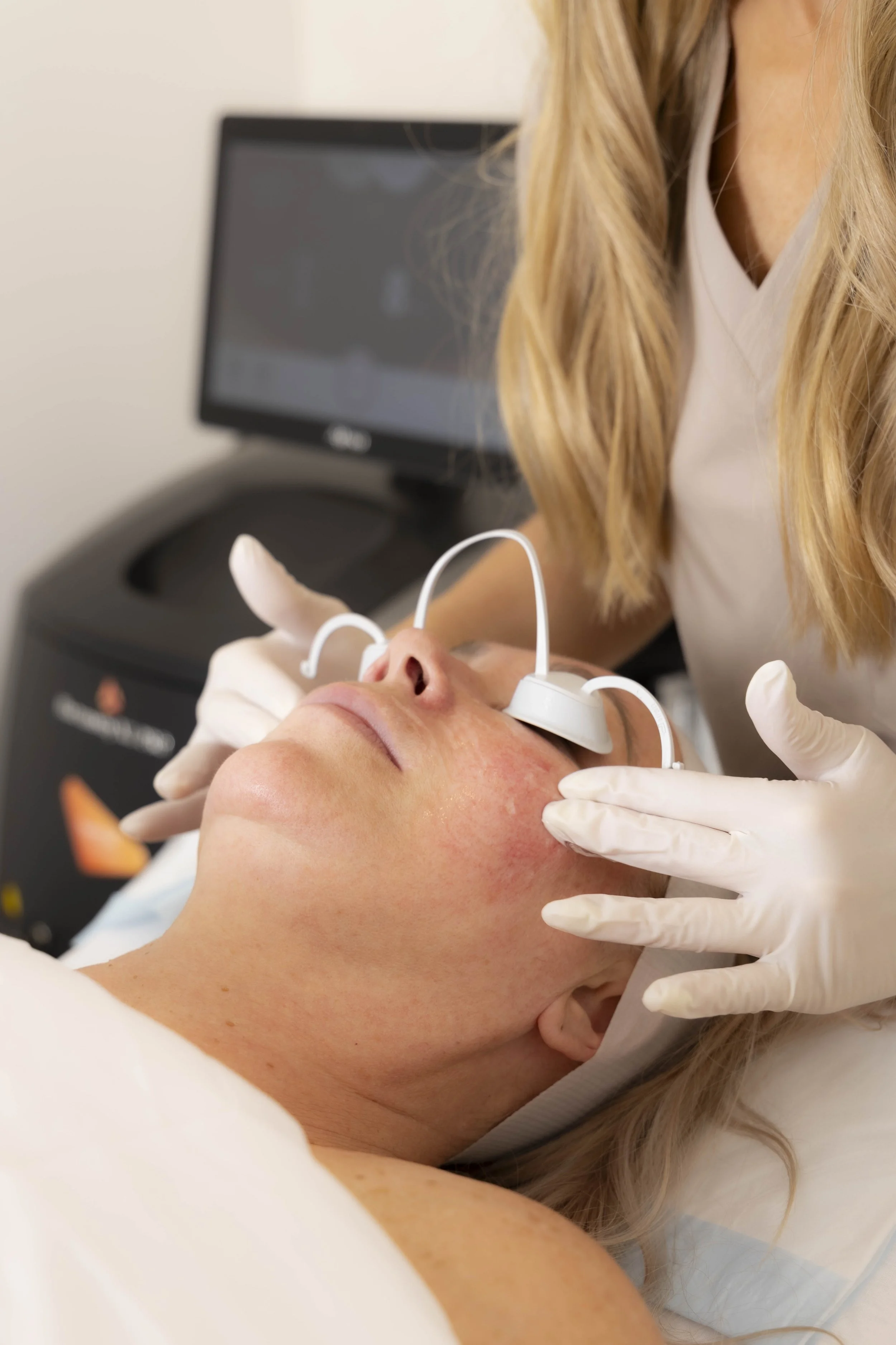Laser treatment for broken capillaries, pigmentation and redness at BYGOLDEN Parkdale Melbourne