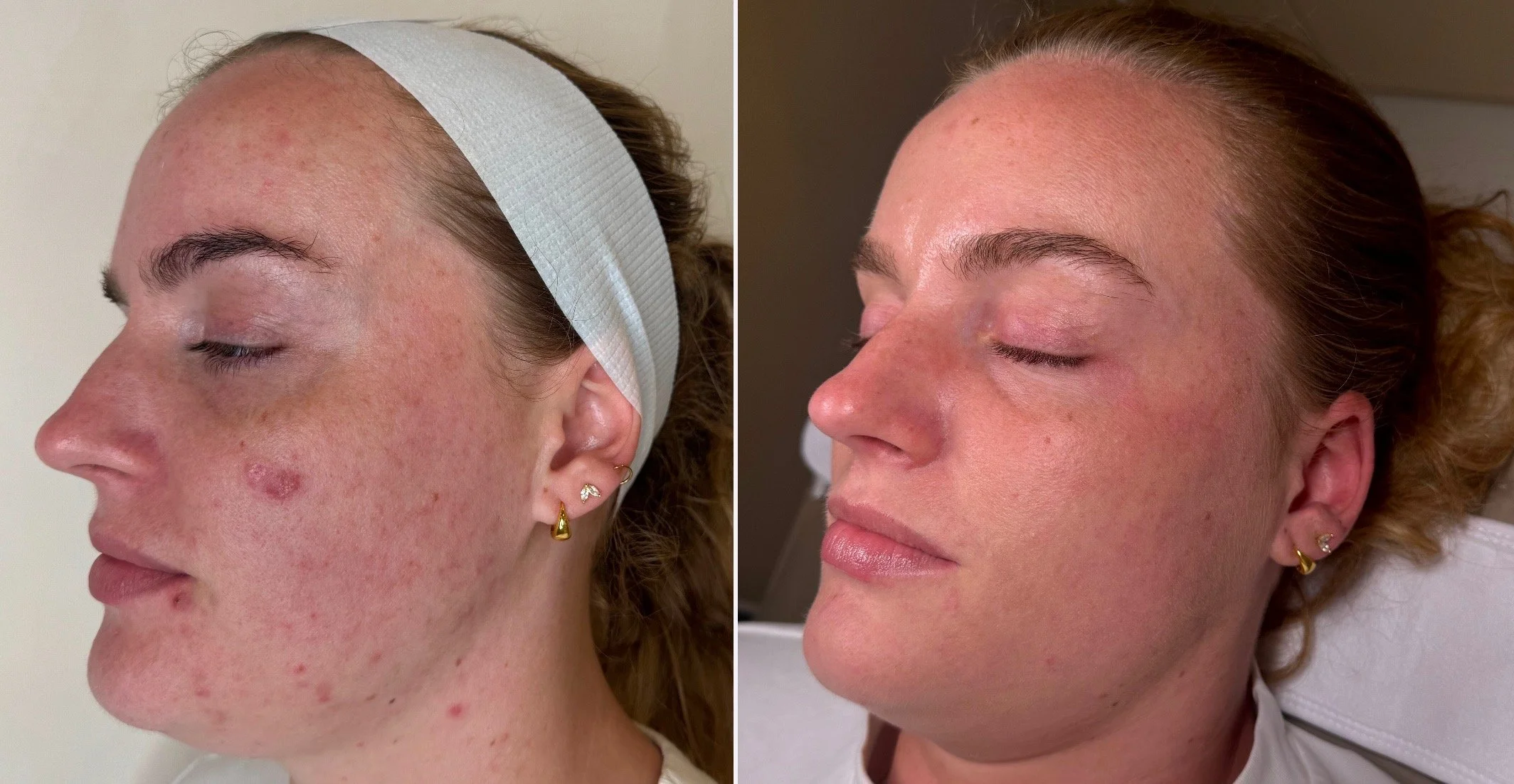 Acne and acne scarring treatment at BYGOLDEN Parkdale Melbourne