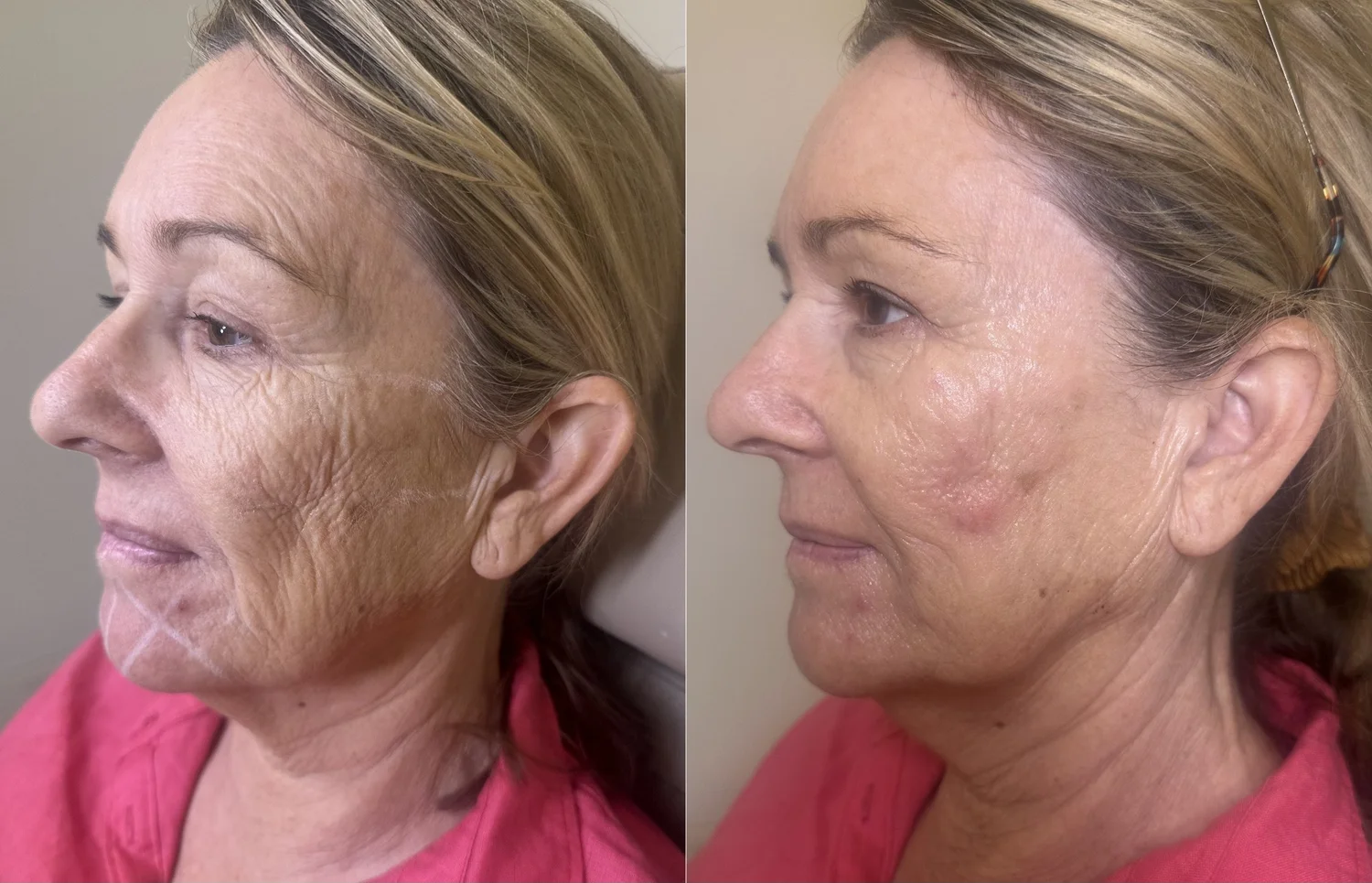 Before and after one bio-remodelling treatment at BYGOLDEN Parkdale Melbourne