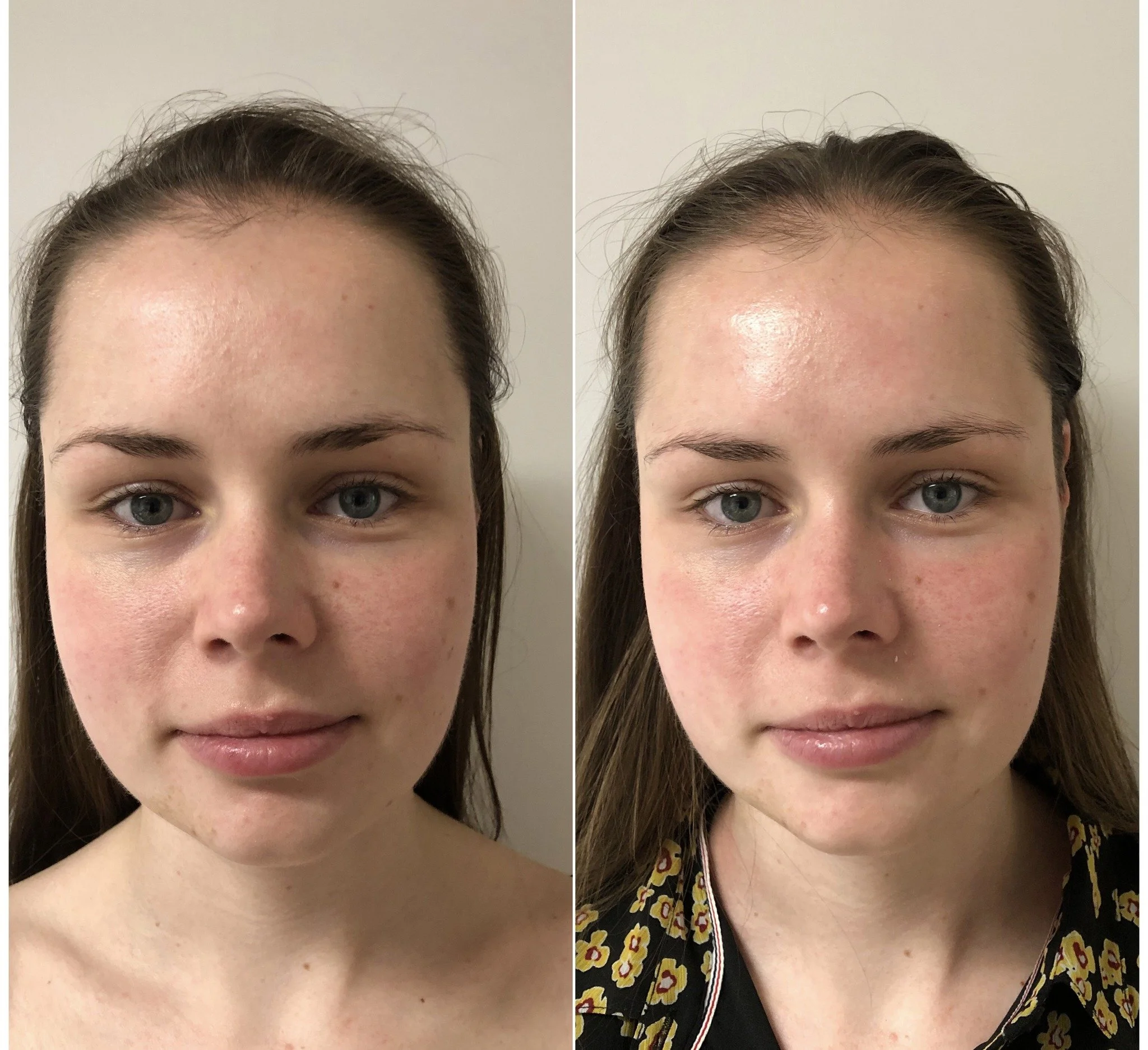 De Guasha Gezichtsbehandeling! Deze behandeling zorgt voor een natuurlijke lift en bevordert de doorbloeding, terwijl onze zorgvuldig maskers de huid een diepe flow geven. Een perfecte combinatie van verzorging en ontspanning! #Guasha #NatuurlijkeLif