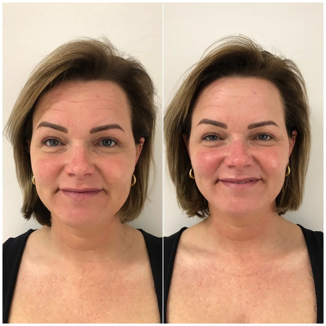 Directe resultaat na eerste guasha gezicht behandeling ✨

Wens jij ook dezelfde resultaten en wil je heerlijk ontspannen, maak dan gauw die afspraak voor jezelf 🌿💆&zwj;♀️