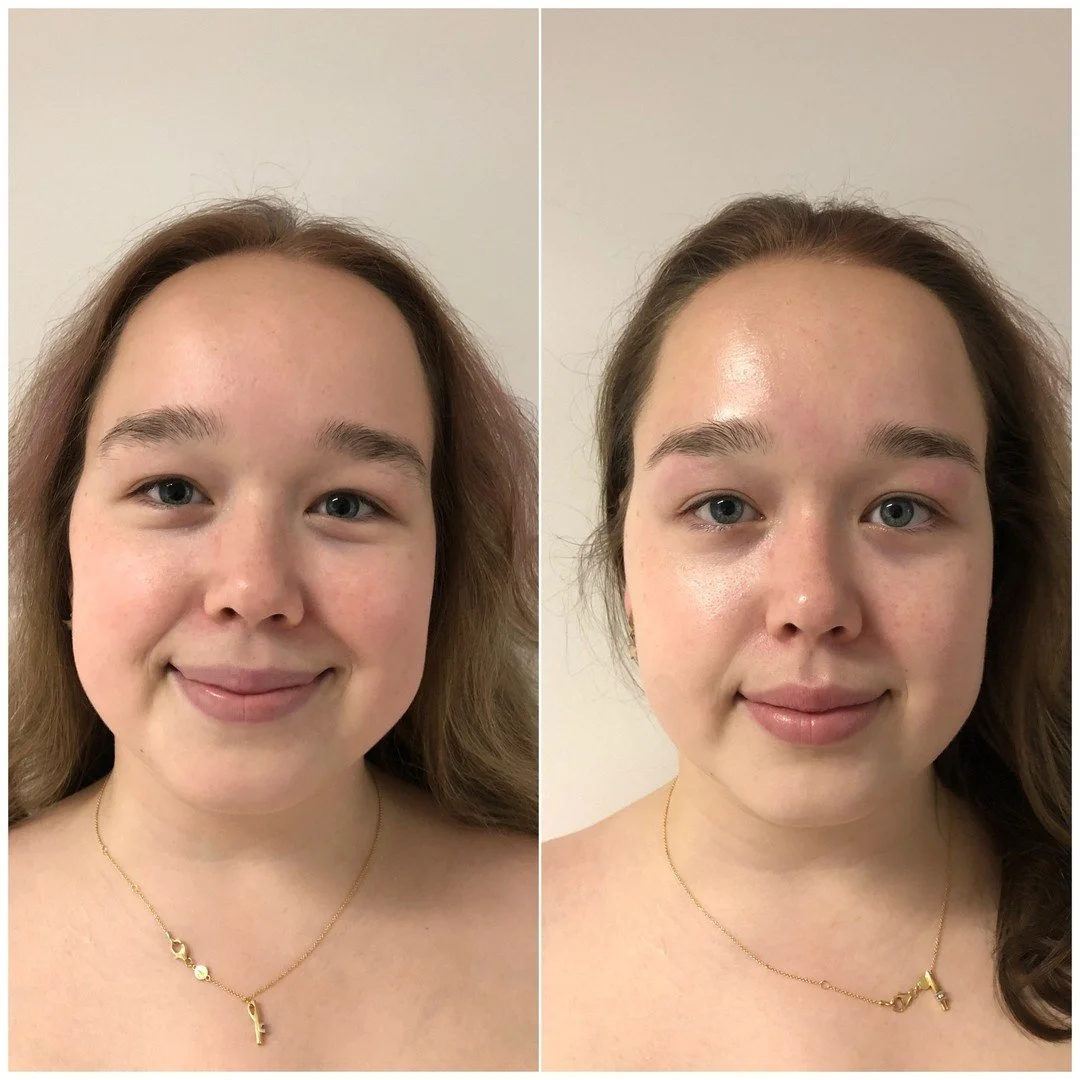 De resultaten na een guasha behandeling gecombineerd met een diamond peel. Gepast voor jong en ouder! Wil je meer weten over deze behandeling? Stuur dan een bericht 🥰
