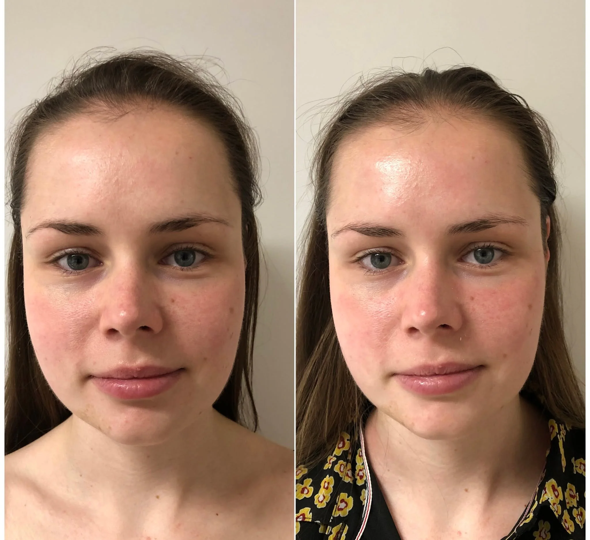 De Guasha Gezichtsbehandeling! Deze behandeling zorgt voor een natuurlijke lift en bevordert de doorbloeding, terwijl onze zorgvuldig maskers de huid een diepe flow geven. Een perfecte combinatie van verzorging en ontspanning! #Guasha #NatuurlijkeLif