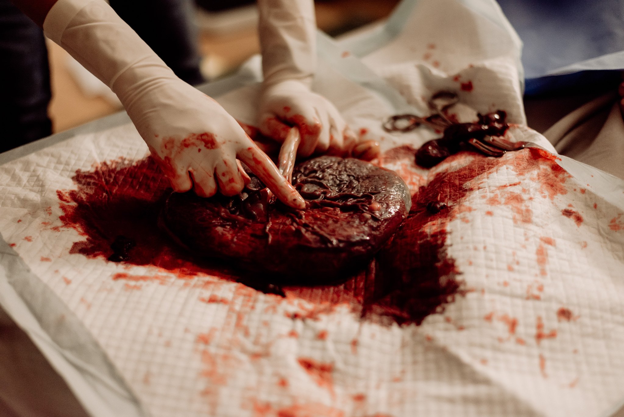 A person wearing gloves handling a large, bloody organ, possibly a heart, on a bloodstained cloth or surgical drape.