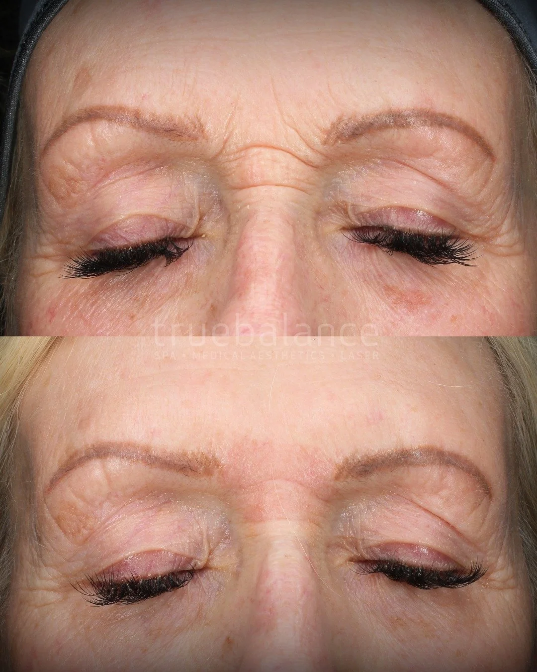 We're still not over these results!
ㅤ
This client came to us with deep static lines and texture in the glabella (between the brows) region. An area that requires a layered, strategic approach for long-term improvement.
ㅤ
⚡ With the expertise of our L