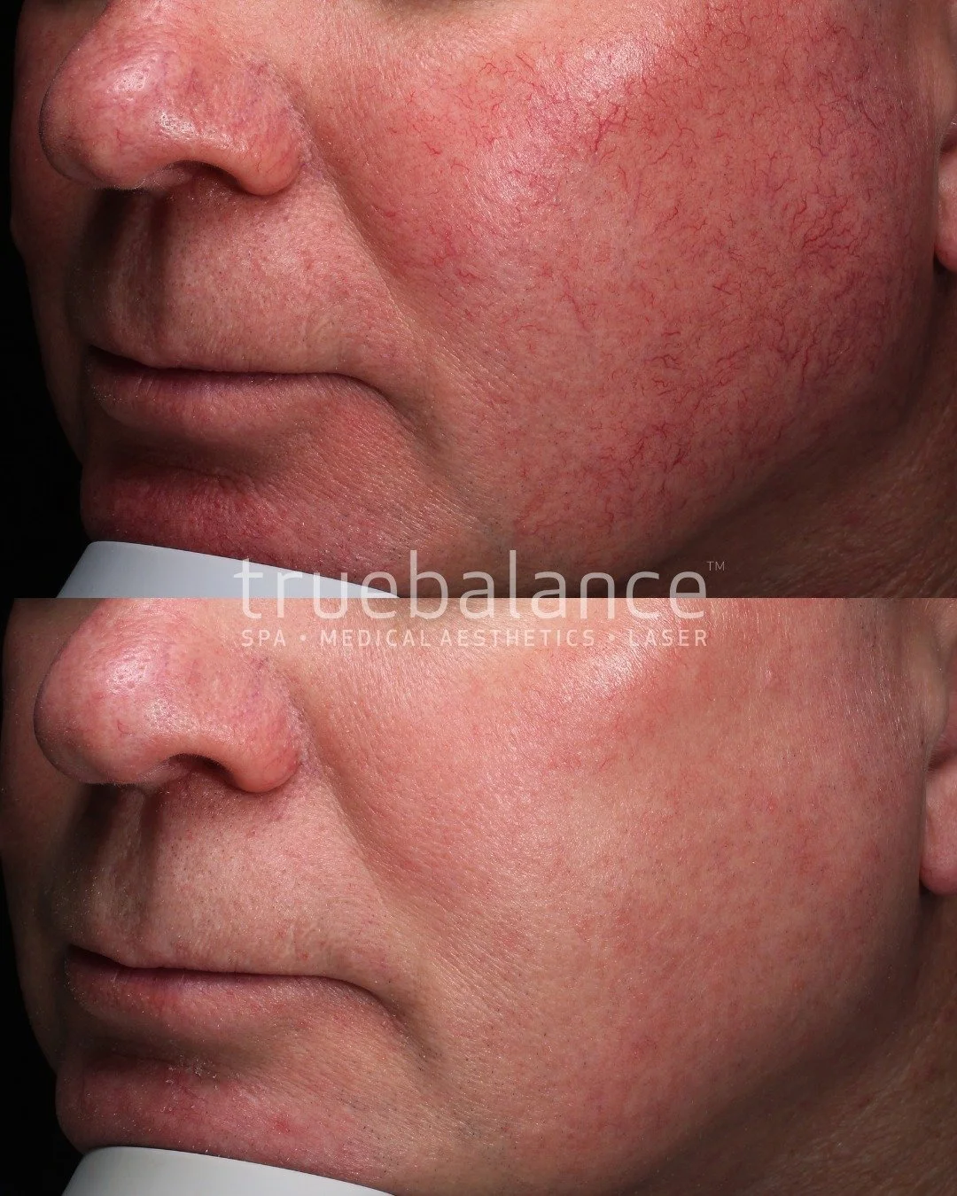 ⚡️JUST 3 IPL SESSIONS
ㅤ
As seen on this client, their concern was the rosacea on their cheeks and lower face.
ㅤ
With only 3 sessions, 3 weeks apart, we were able to reduce the appearance of the vessels and redness, and give their skin an overall reju
