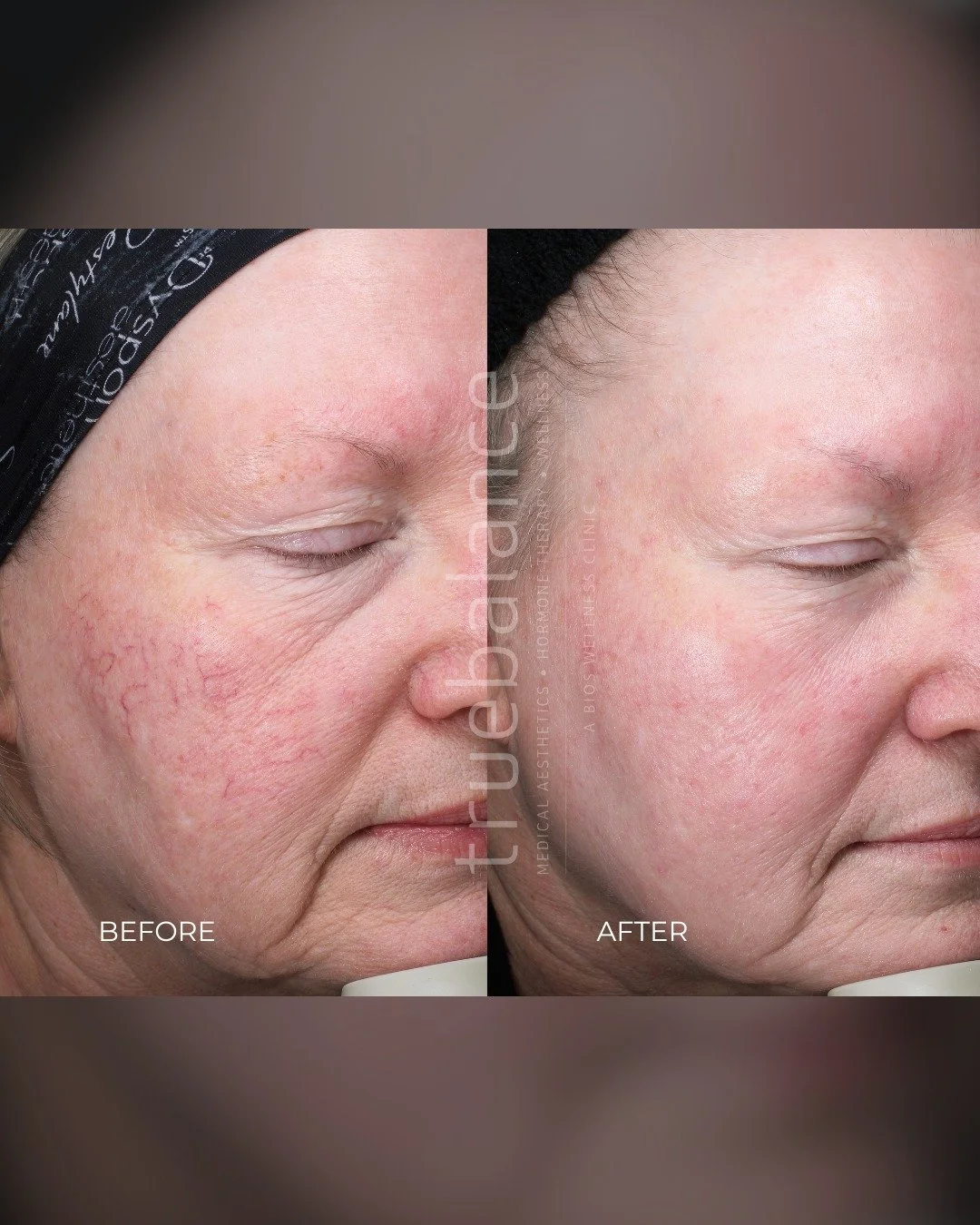 Before and after, clarity you can see. 
These IPL results by Margherita in St. Albert highlight visible improvement in overall skin tone and complexion. 
IPL works by targeting pigment and vascular irregularities, helping to reduce the appearance of 