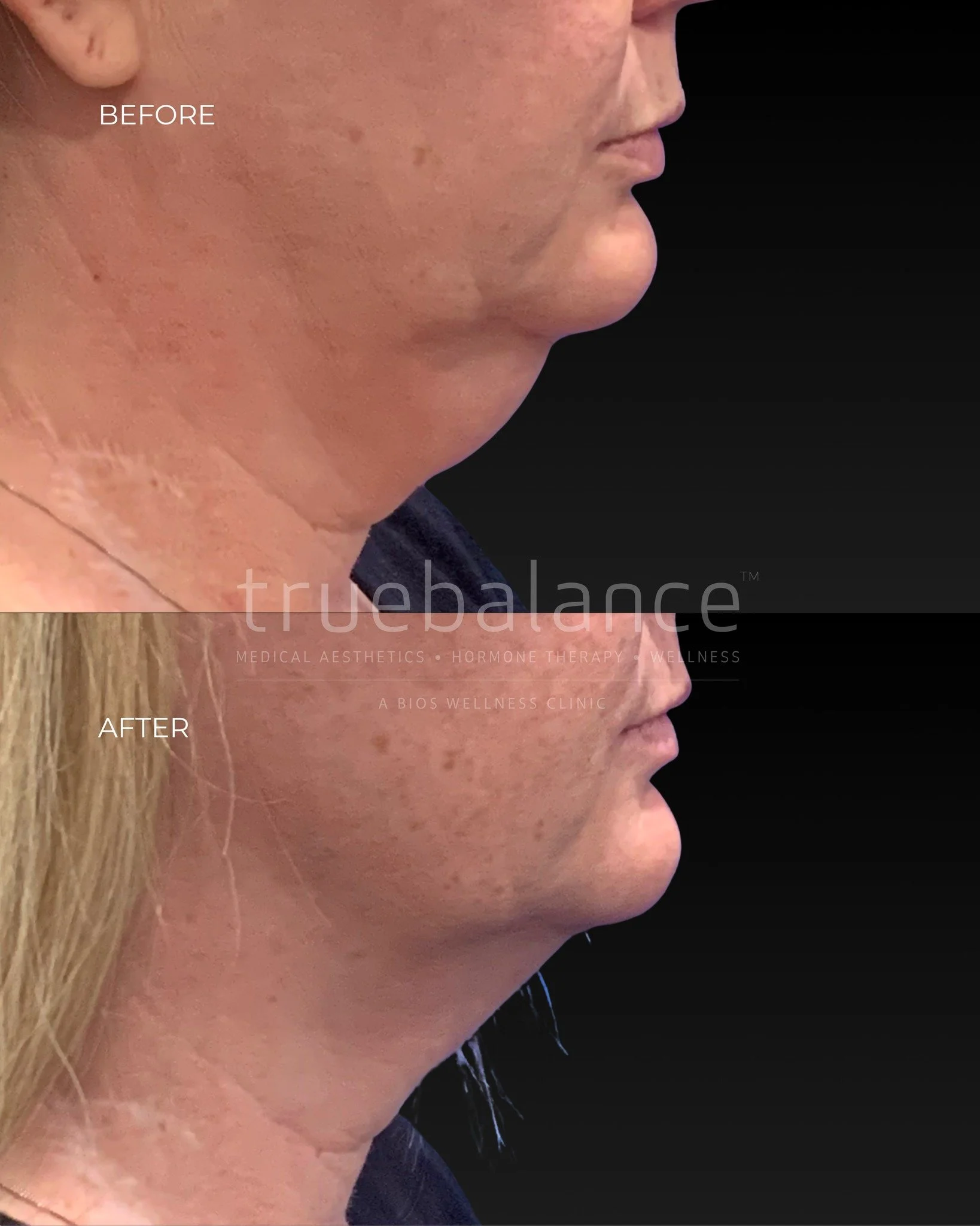 Before and after, results you can see. 

This SculpSure treatment by Margherita in St. Albert highlights visible contour improvement using advanced, non-surgical technology. 

It&rsquo;s an option for areas that feel resistant to results despite cons