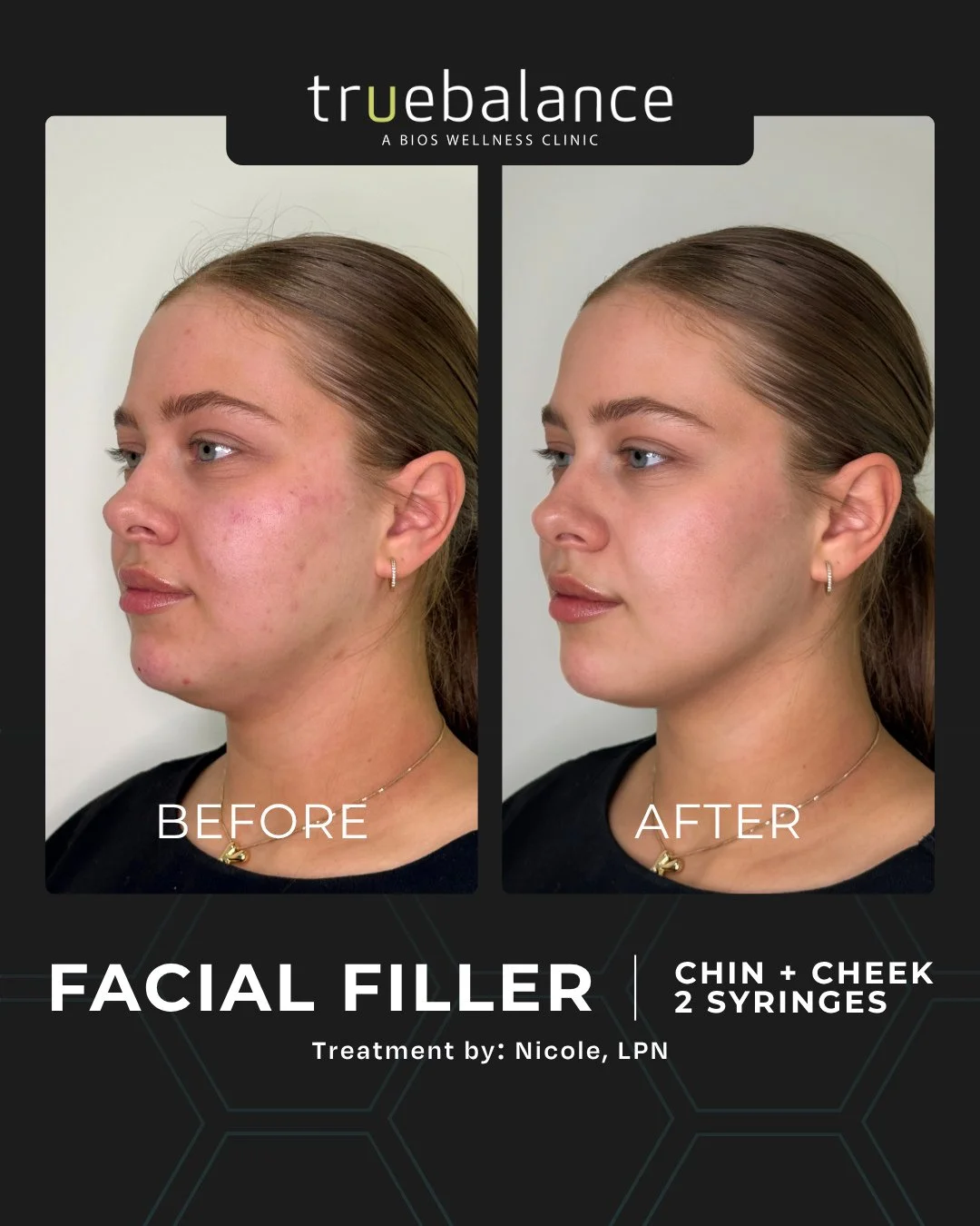 Chin and cheek filler, two syringes, one appointment.⁠
⁠
You can see what a little structure does. A more defined jawline, lifted cheeks, and a smoother profile from this angle. Same person, just better balance through the lower face.⁠
⁠
A lot of peo