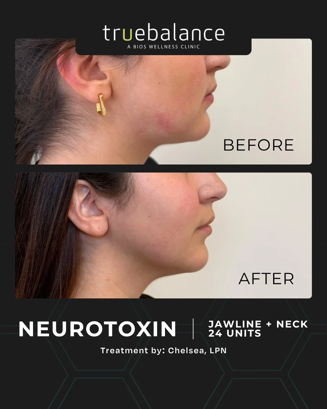 Not every result is dramatic. Some are the kind only you notice, in the mirror, in photos, in how your jaw and neck look at the end of a long day. ⁠
⁠
This is a neuromodulator treatment along the jawline and neck, the area a lot of people don't reali