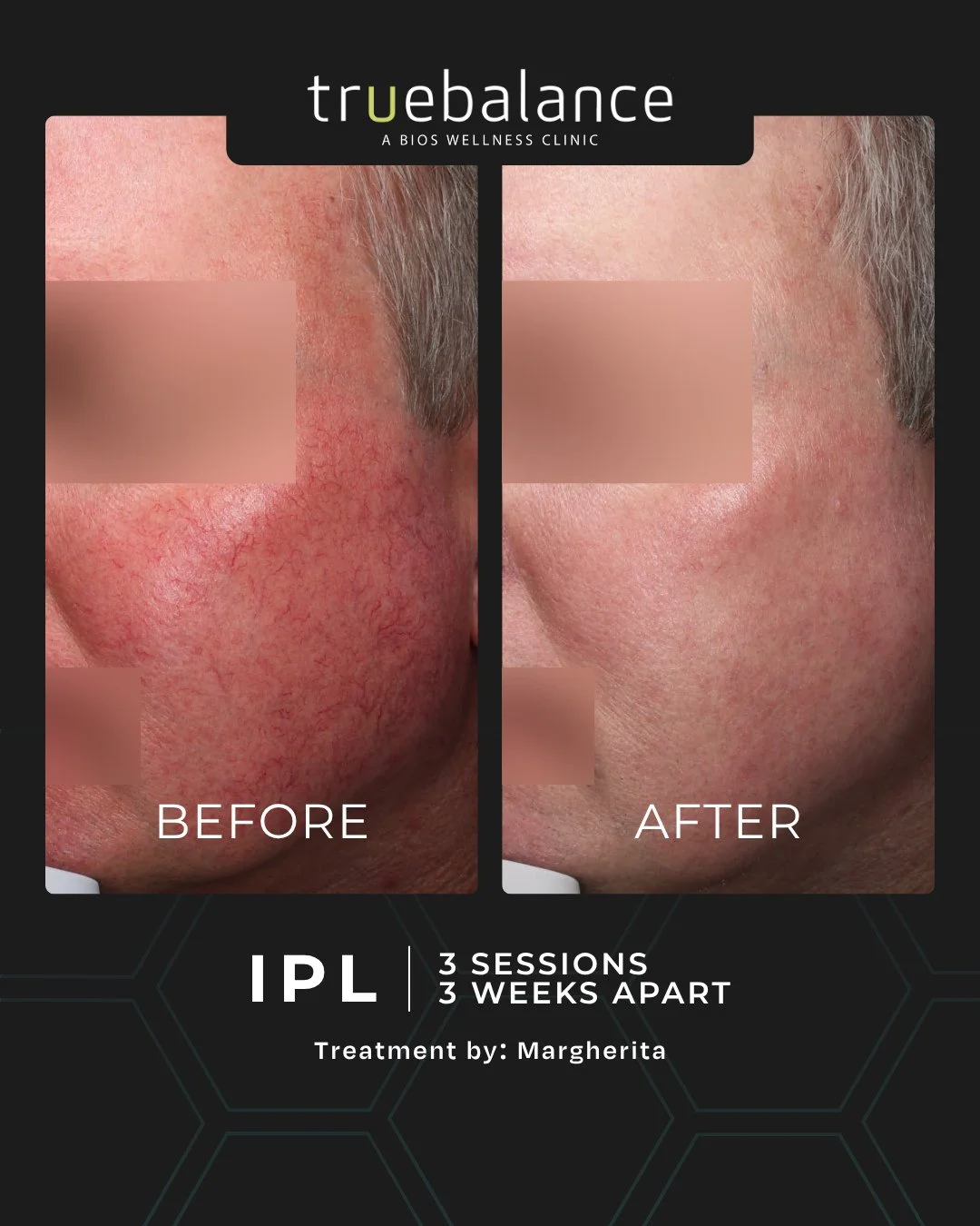Three treatments, spaced three weeks apart, performed by Margherita at our St. Albert location. ⁠
⁠
This client experienced a visible reduction in redness and inflammation with a personalized treatment plan designed to support healthier, more balance