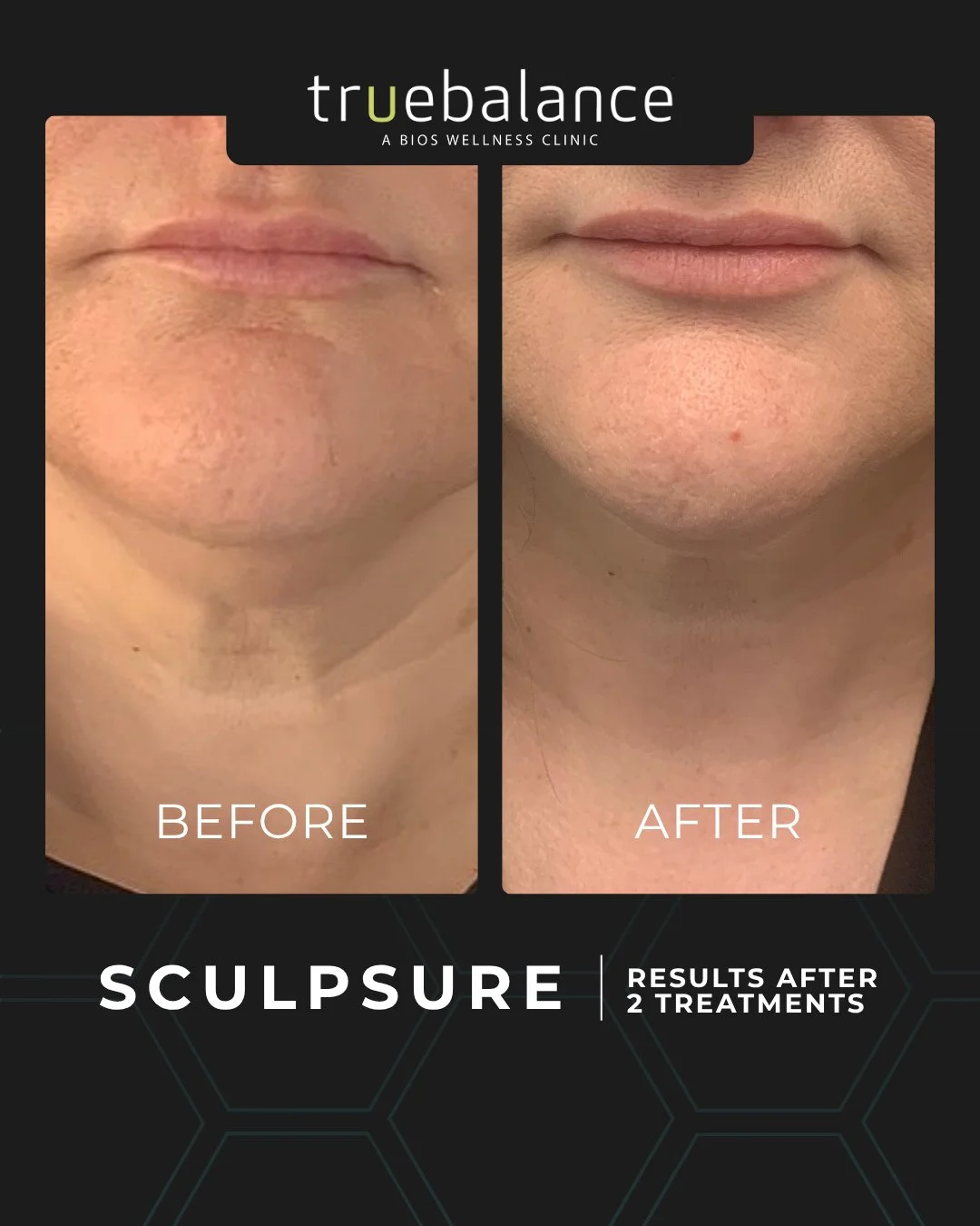 Submental fat is the one nobody can diet away. It sits under the chin, it shows up in every photo taken from below, and it's largely genetic, which is why people who are otherwise happy with their weight still can't shift it. ⁠
⁠
SculpSure heats thos