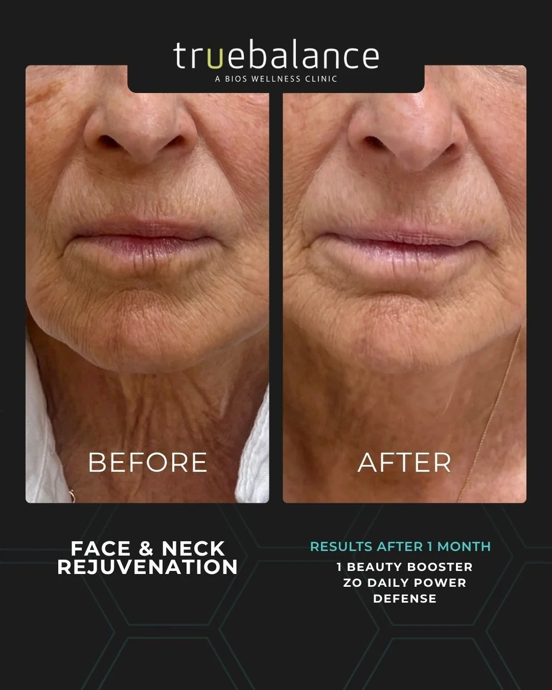 Confidence looks good on everyone. This face and neck rejuvenation result reflects a personalized treatment plan combining a beauty booster with ongoing daily skincare support, captured after one month. Individual results may vary.⁠
�⁠
📅 Ready to bo