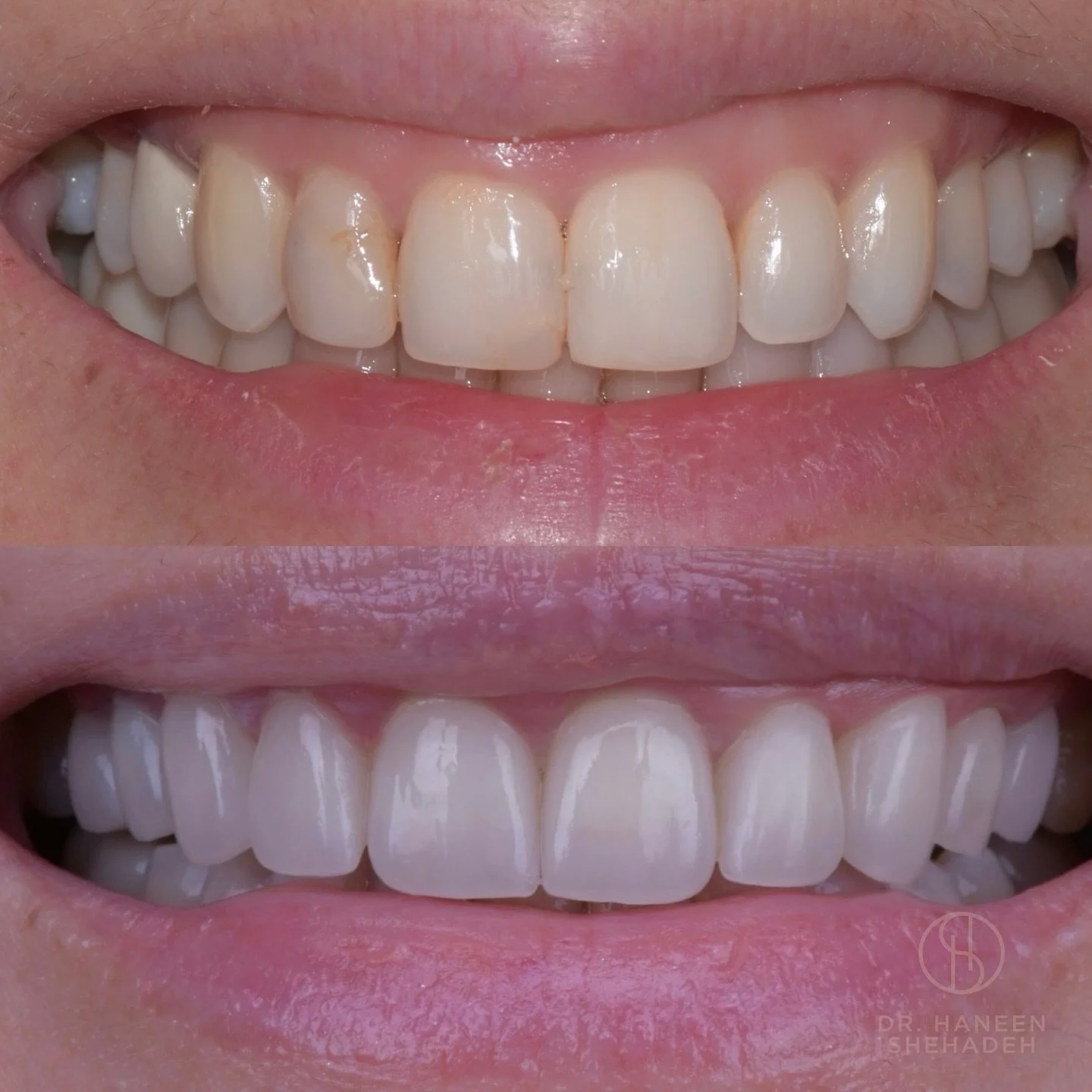 An unforgettable transformation YOU could have too...

Here are the gorgeous results from a gum lift &amp; 10 porcelain veneers. ✨

smile makeover | cosmetic dentists | dream smile | smile designer | cosmetic dentist | straight teeth | teeth whitenin