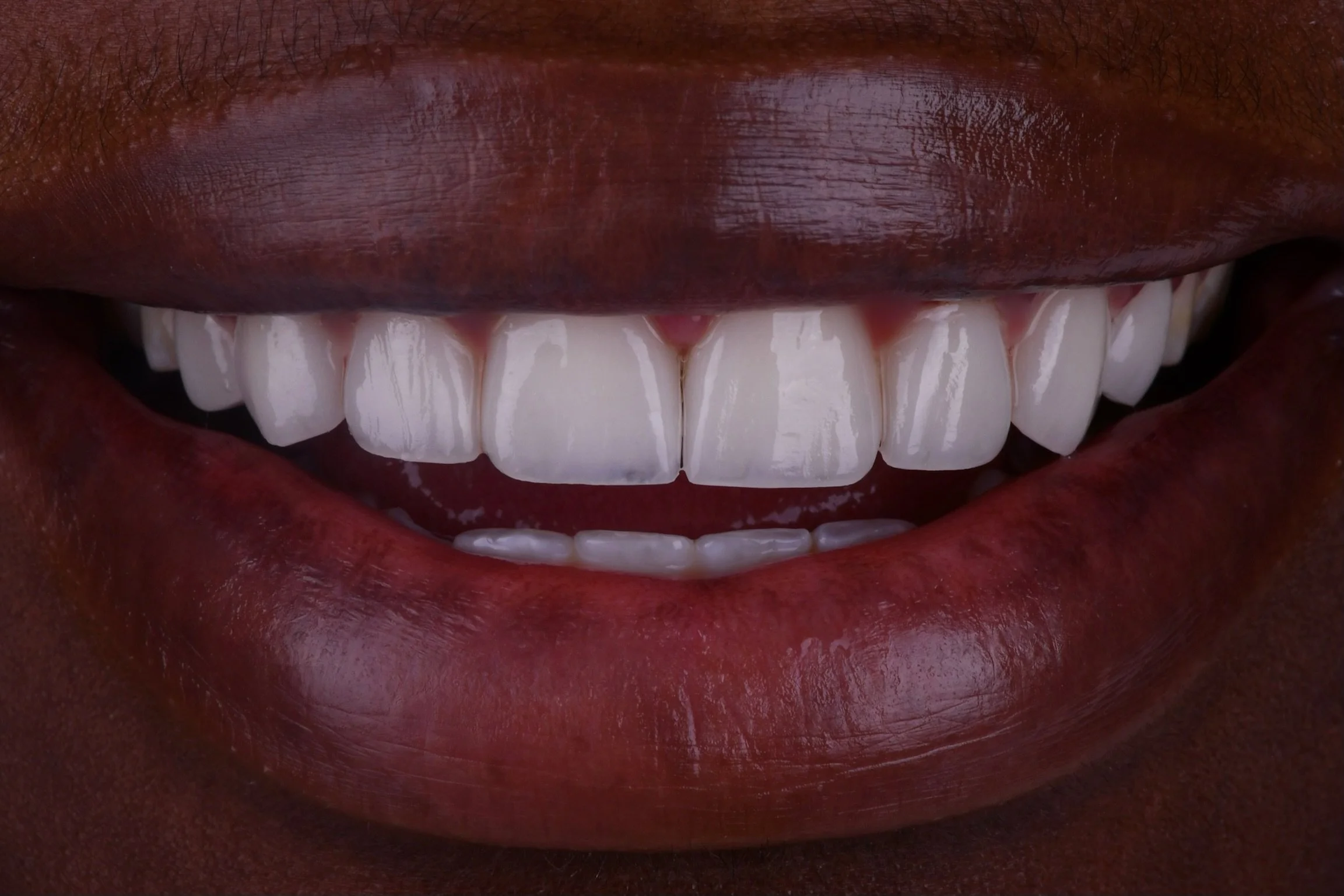 Before & After Porcelain Veneers Miami